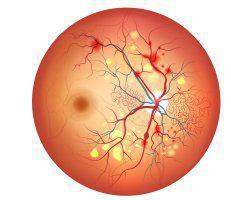 DIABETIC RETINOPATHY