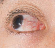 PTERYGIUM SURGERY