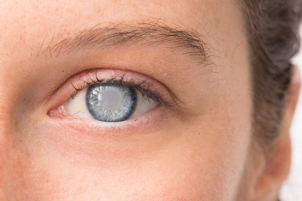 What causes cataracts?